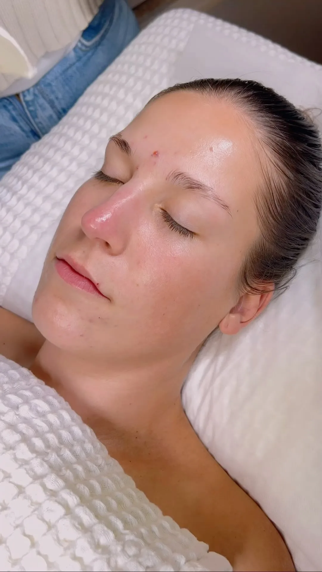 Client receiving skin needling collagen induction therapy, reclining